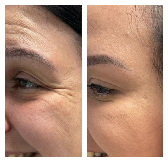 Resultado de procedimento 1