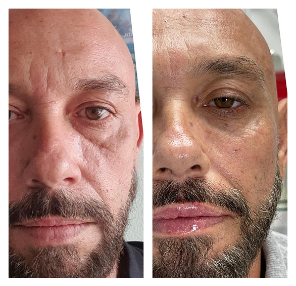 Resultado de procedimento 3