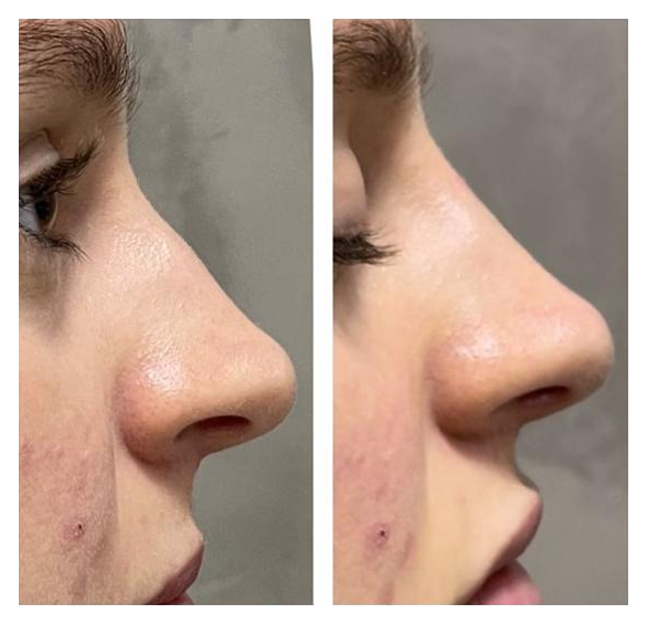 Resultado de procedimento 4