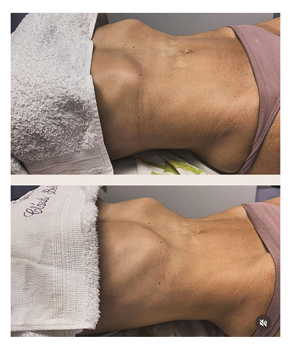 Resultado de procedimento 2