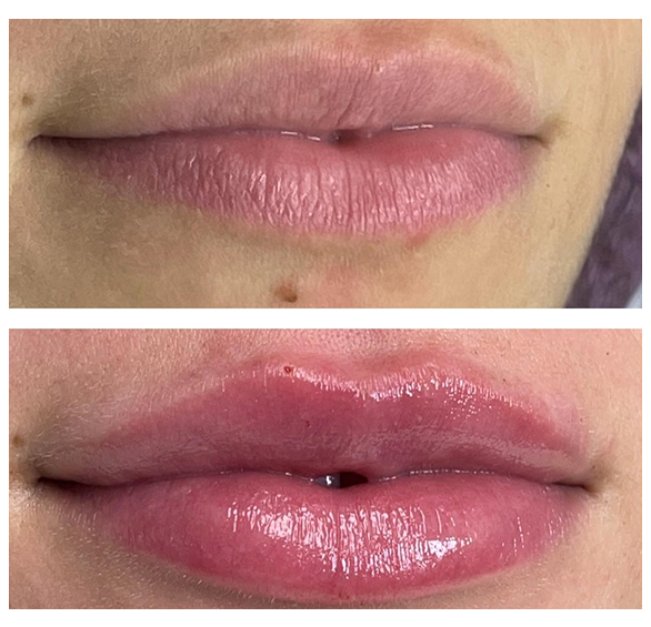 Resultado de procedimento 5